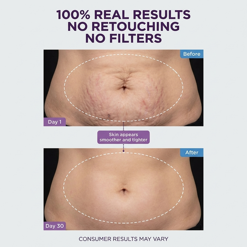 Dermadex™ Tighten and Smooth Belly Cream