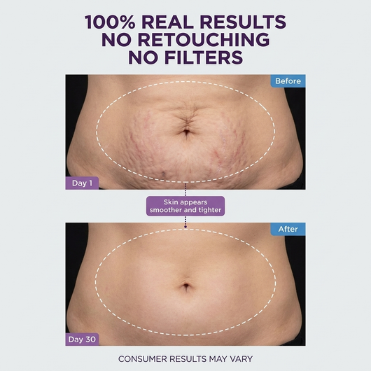 Dermadex™ Tighten and Smooth Belly Cream